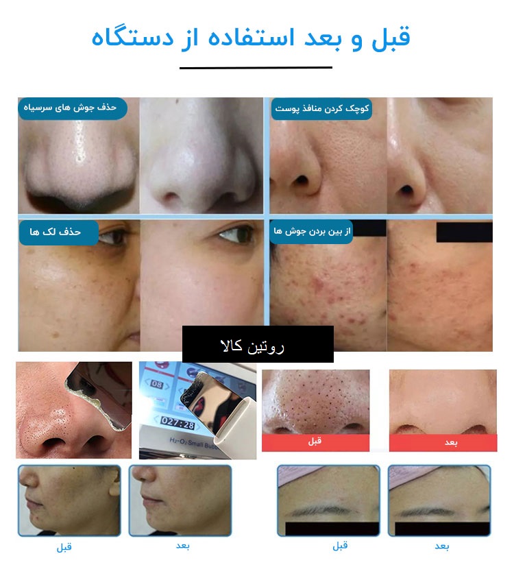 دستگاه پاکسازی و جوانسازی پوست هیدروفیشیال 8 کاره مجهز به دسته مزوگان کلینیکی متور سنگین ("نیوفیس")