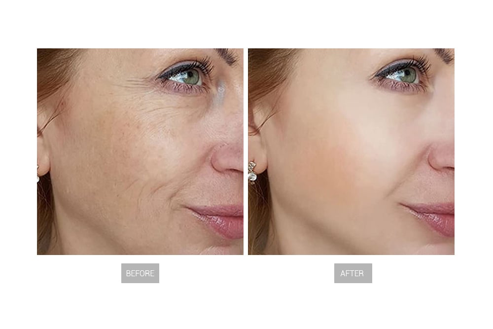  دستگاه هایفو الترا گلد 22 بعدی، جوانساز و لیفت غبغب و صورت