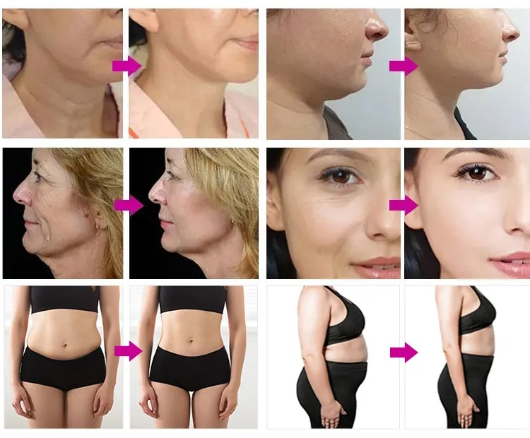 دستگاه هایفو الترا گلد 22 بعدی، جوانساز و لیفت غبغب و صورت