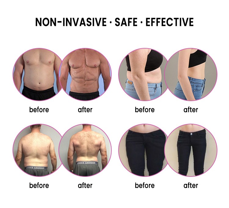 دستگاه لیزر سبز ۶ بعدی لاغری بدن (532 نانومتر)