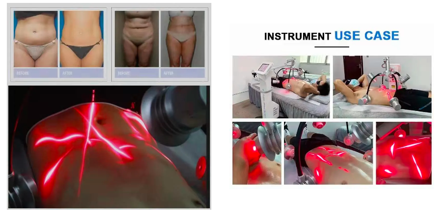 دستگاه لیزر سبز ۶ بعدی لاغری بدن (532 نانومتر)