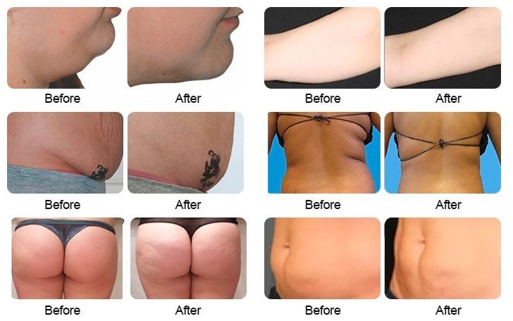 دستگاه لیزر سبز ۶ بعدی لاغری بدن (532 نانومتر)