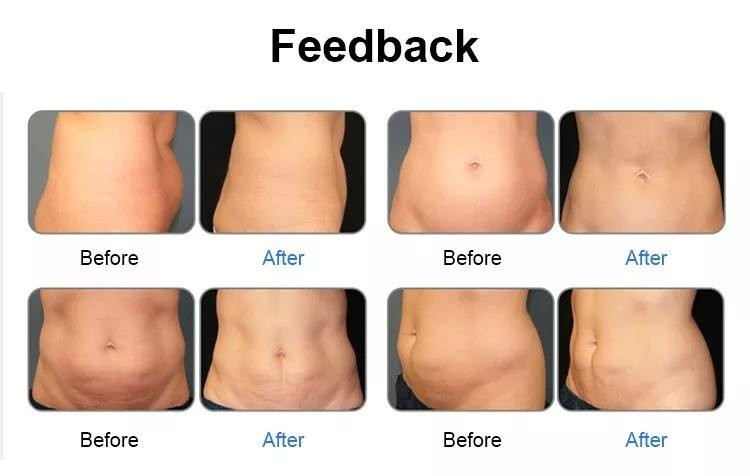 دستگاه لیزر سبز ۶ بعدی لاغری بدن (532 نانومتر)