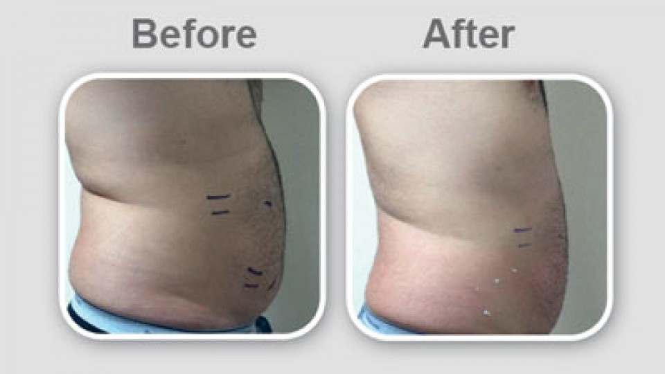 بهترین روش لاغری شکم با EMS